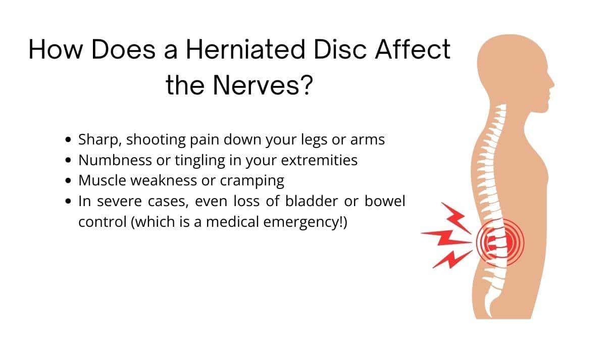 What Is Disc Syndrome and Their Different Levels? 2 DiscSyndrome3