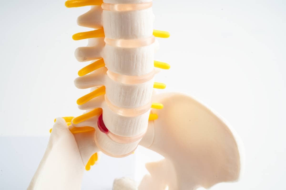 A Guide: How To Heal A Bulging Disc Naturally 1 How To Heal A Bulging Disc Naturally