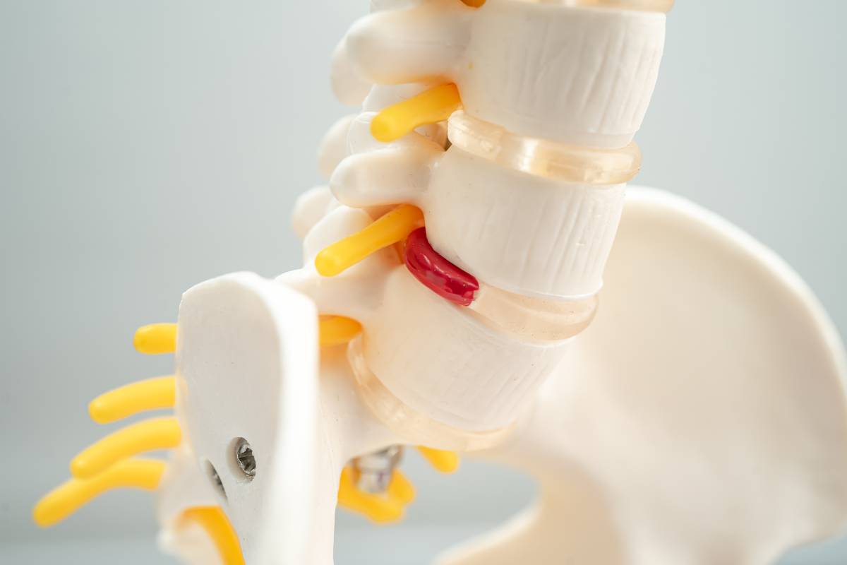 How Does Non-Surgical Spinal Decompression Treatment Help? 2 Non-Surgical Spinal Decompression Treatment